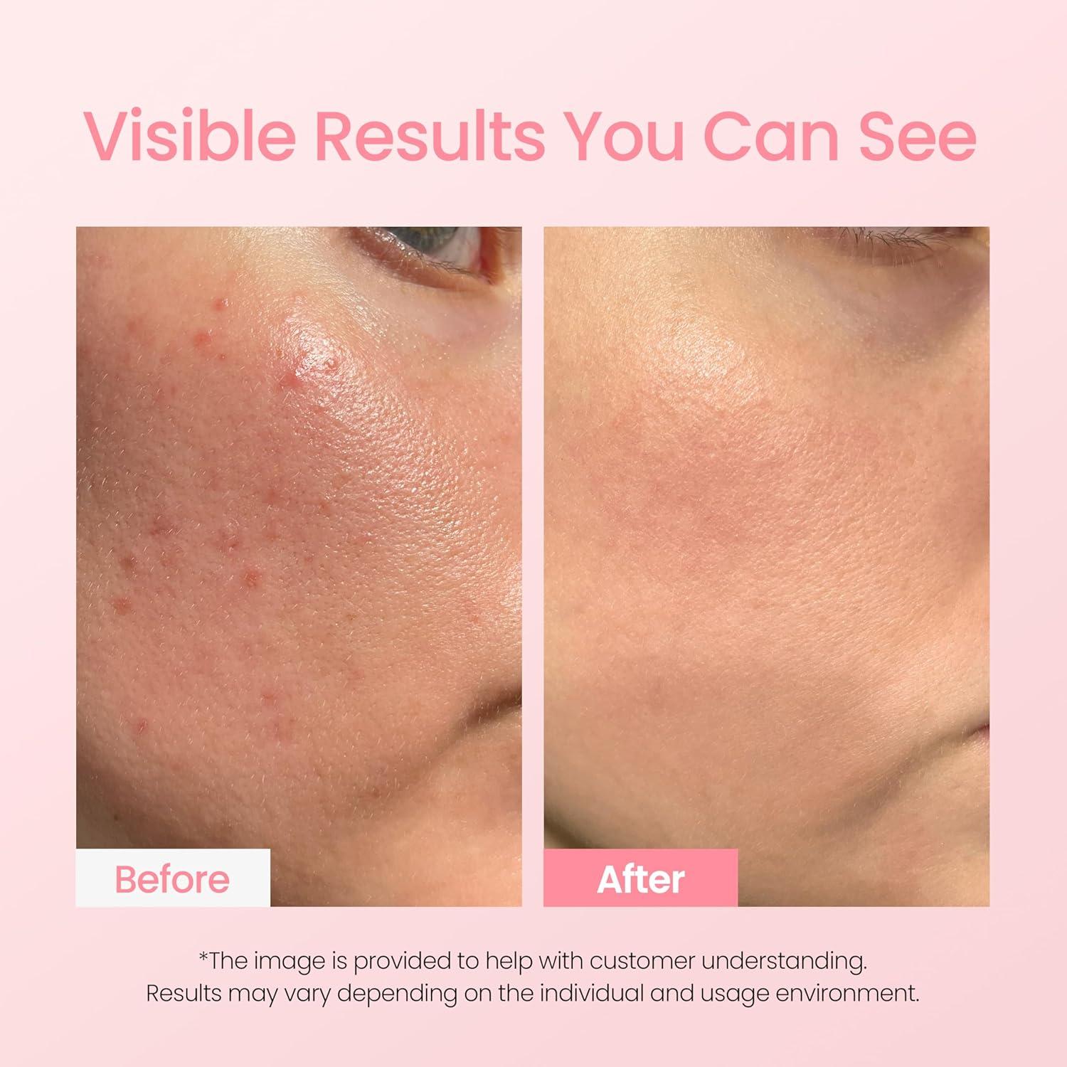 imageNEOGEN AClear Soothing Pink Eraser Spot Care Blemish Care Korean Skin Care Pink Pimple Drying Power Calamine Powder Nighttime Spot for Face and Skin 050 Fl Oz